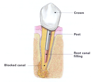 endodontic retreatment image