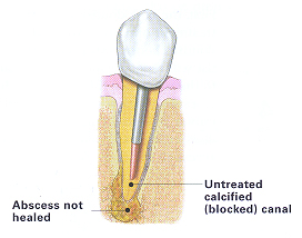 endodontic retreatment image